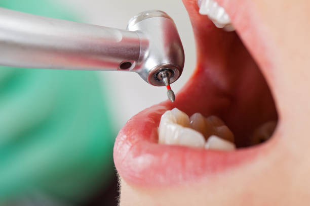 Best Emergency Tooth Extraction in Lake Hamilton, AR